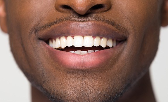 Closeup of smile after cosmetic dental bonding
