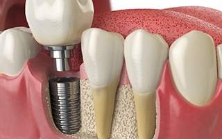 Render of single dental implant in Rockwall, TX
