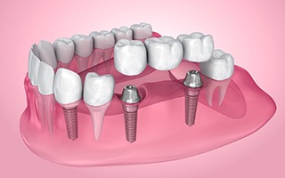 Render of a dental bridge and dental implants in Rockwall, TX