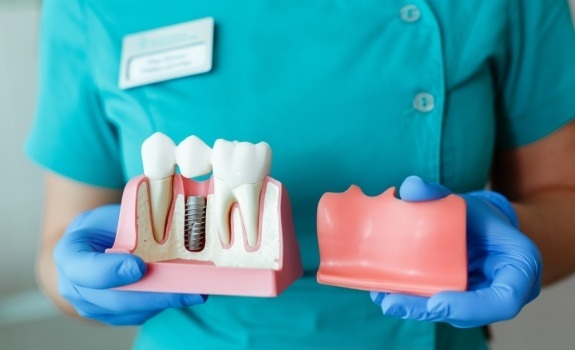 Dentist holding up a model of a natural tooth and dental implant supported tooth