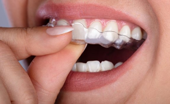 close up person inserting their aligners 