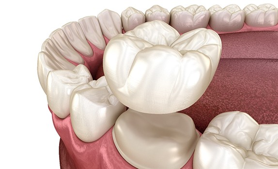 Illustration of dental crown being placed on tooth
