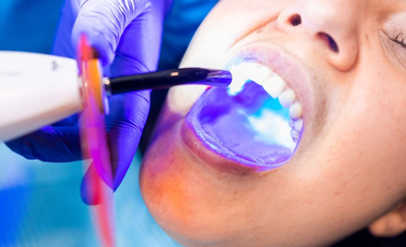 Dental curing light being used in patient’s mouth