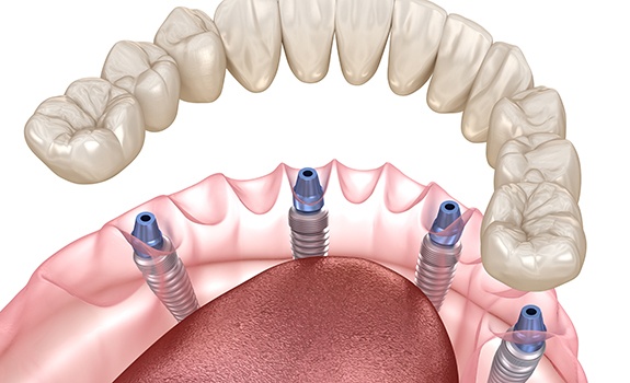 Digital illustration of All-on-4 dental implants