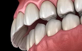 Rendering of an overbite with a black background