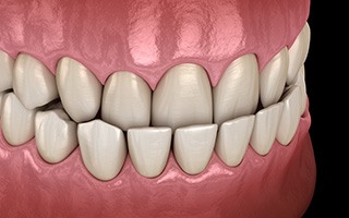 Rendering of an underbite with a black background