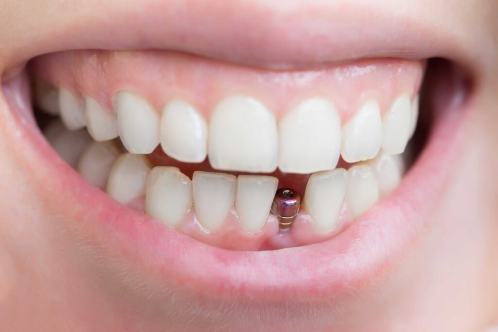 Woman with a dental implant